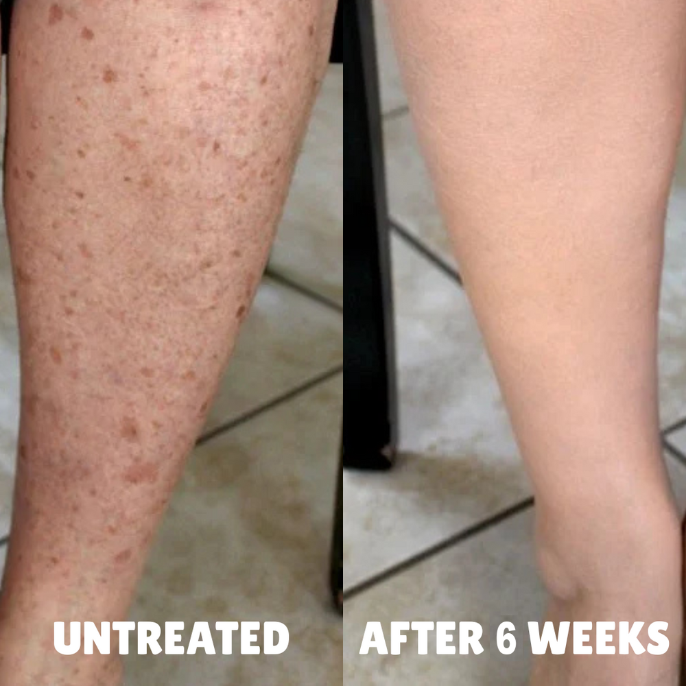 Before and after: untreated vs after 6 weeks