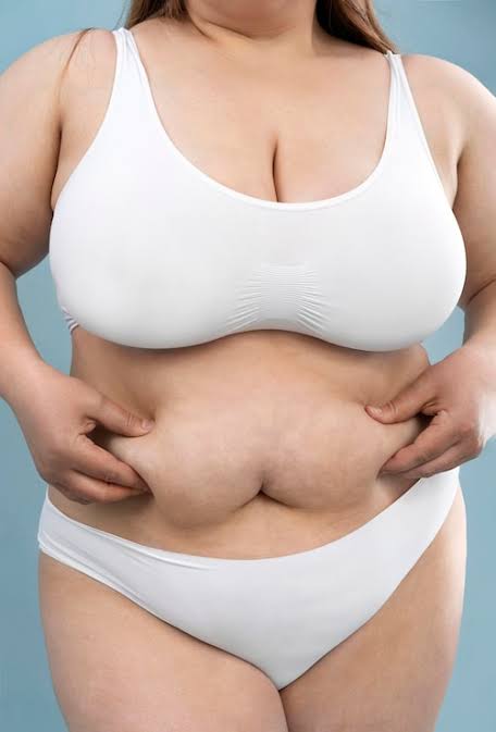 pcos belly fat